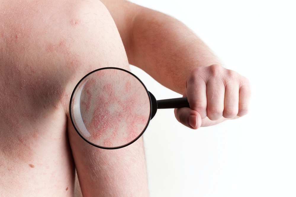 Picture of person with a magnifying glass over psoriasis flare-up on back of shoulder