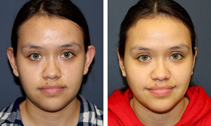 before and after Otoplasty